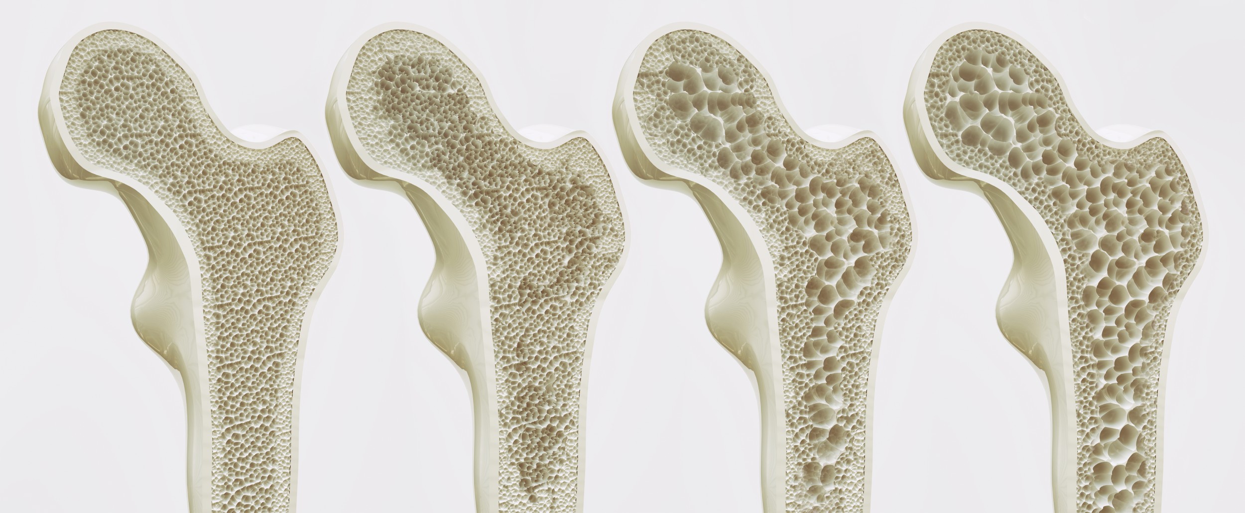 Osteoporosis: The Quiet Epidemic That Imperils Our Bones