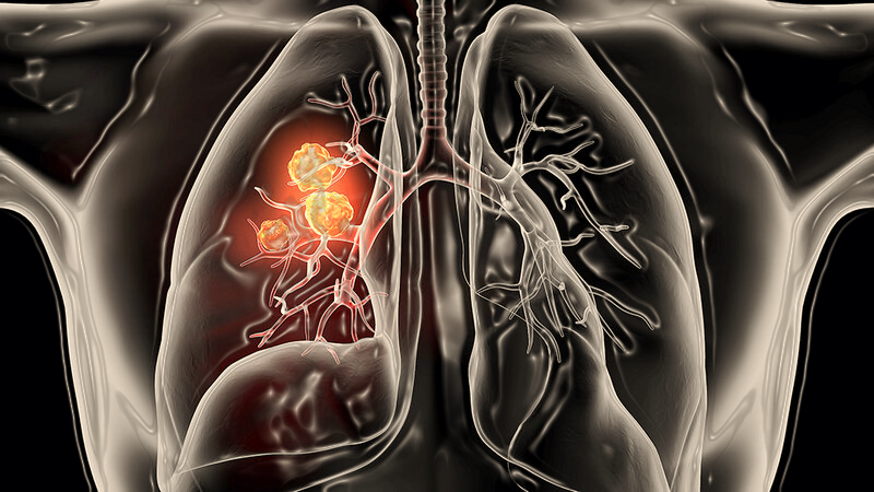 Lung Cancer Stages and 5-Year Survival Rates